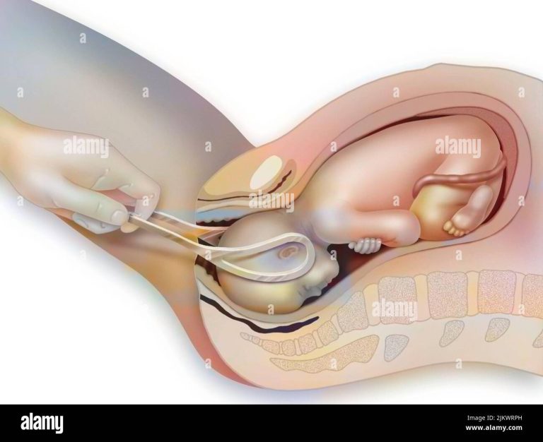 childbirth assistance childbirth with the use of forceps 2JKWRPH